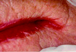 Photo of older woman's dry and cracked lips