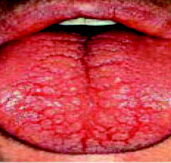 Photo of tongue with cracks and swelling.