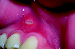 Photo of gum with ulcer