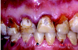 Photo of unhealthy mouth with decaying teeth with black and brown spots.